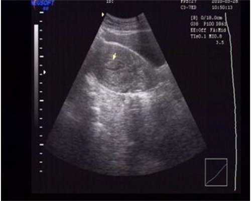 江西供卵代生咨询，江西二代试管哪家医院好？江西做二代试管去哪做？