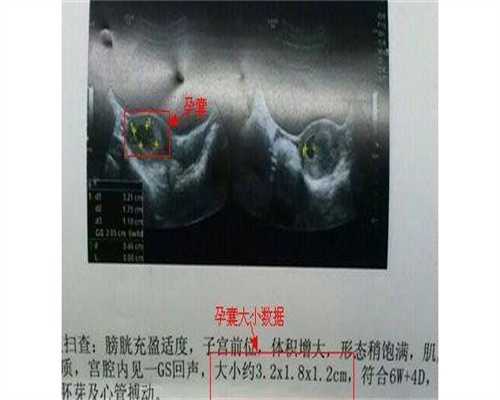 供卵价钱表-孕囊萎缩会自然流产吗